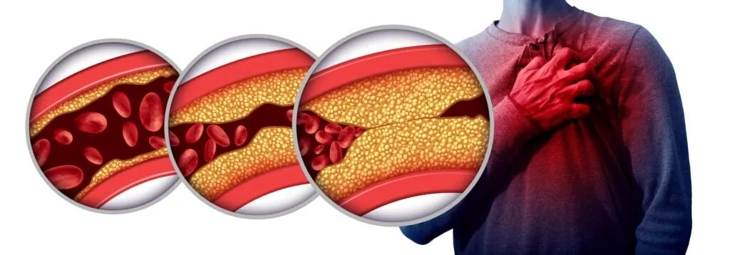 Colesterol alto: o que causa, quais são os tipos, como identificar e prevenir