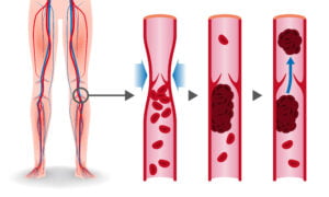 A trombose ocorre quando há formação de um coágulo sanguíneo em uma ou mais veias das pernas e coxas. 