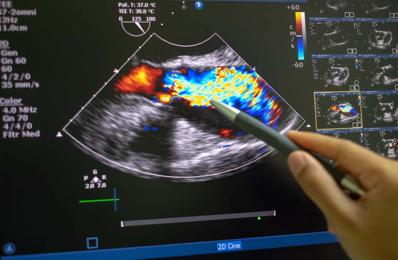 Ecocardiograma com Doppler – o que é, para que serve e quem deve fazer ...